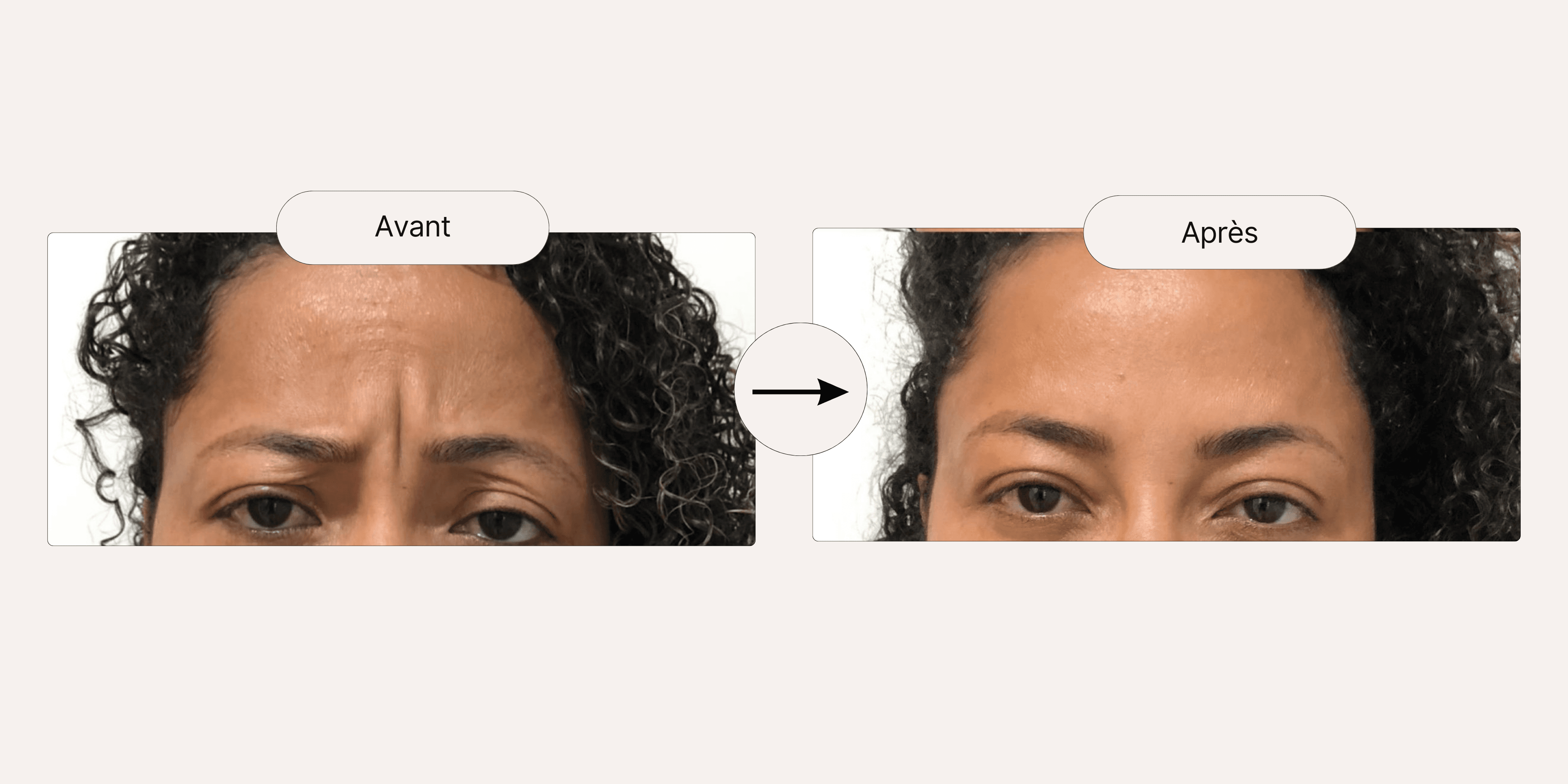 Toxine Botulique - Resultat 1